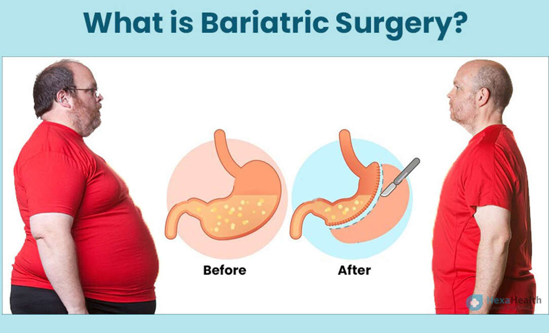 Bariatric